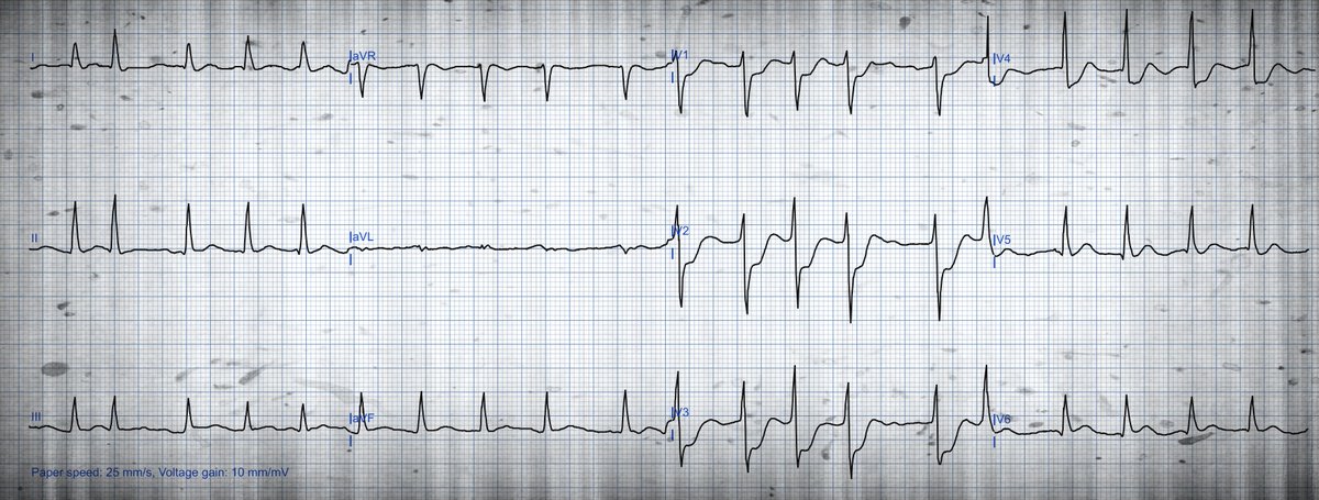 A very nice one 😀 This ECG of an elderly gentleman was sent to me with the question of whether the existing chest pain can be explained by the rapid conduction in atrial fibrillation with signs of subendocardial ischemia in the anterior chest leads. What do you think?