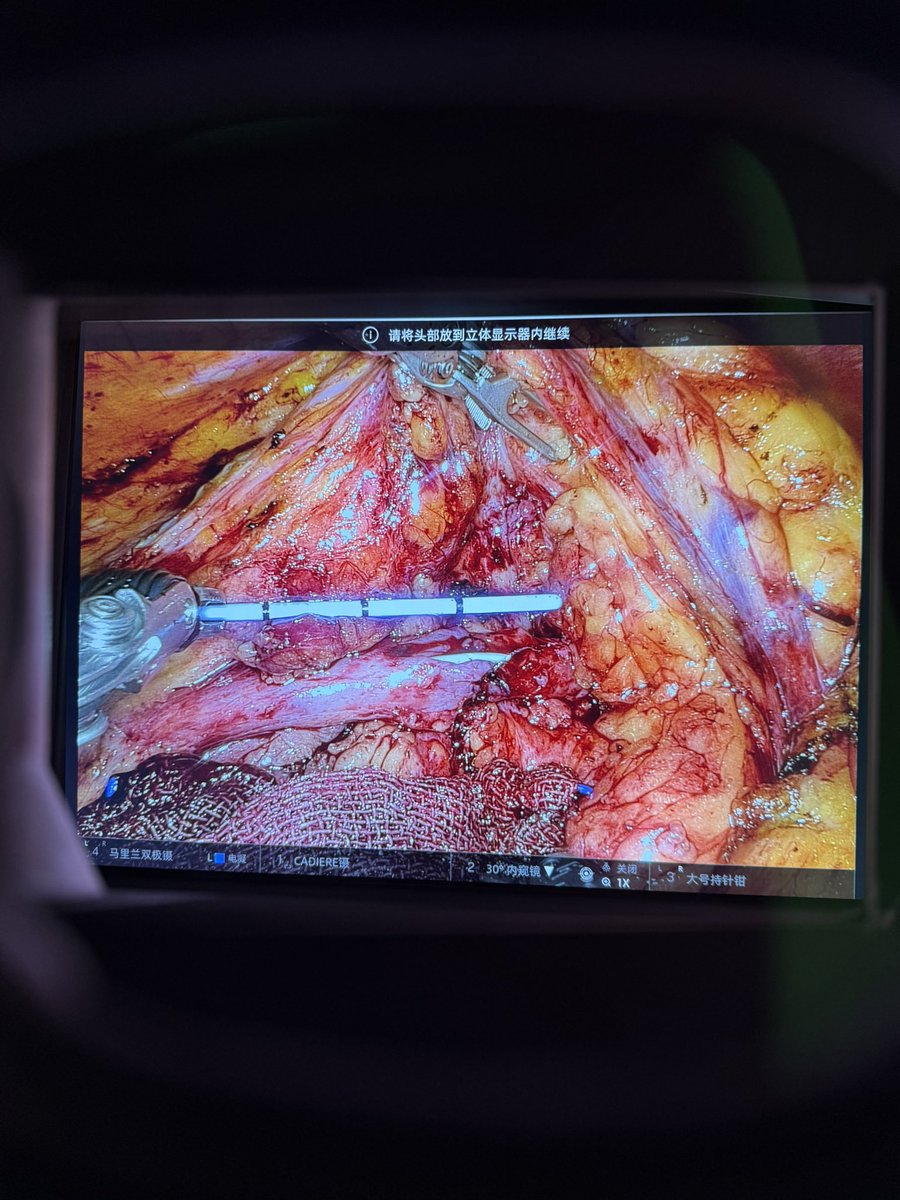 Three cases of BMG ureteroplasty