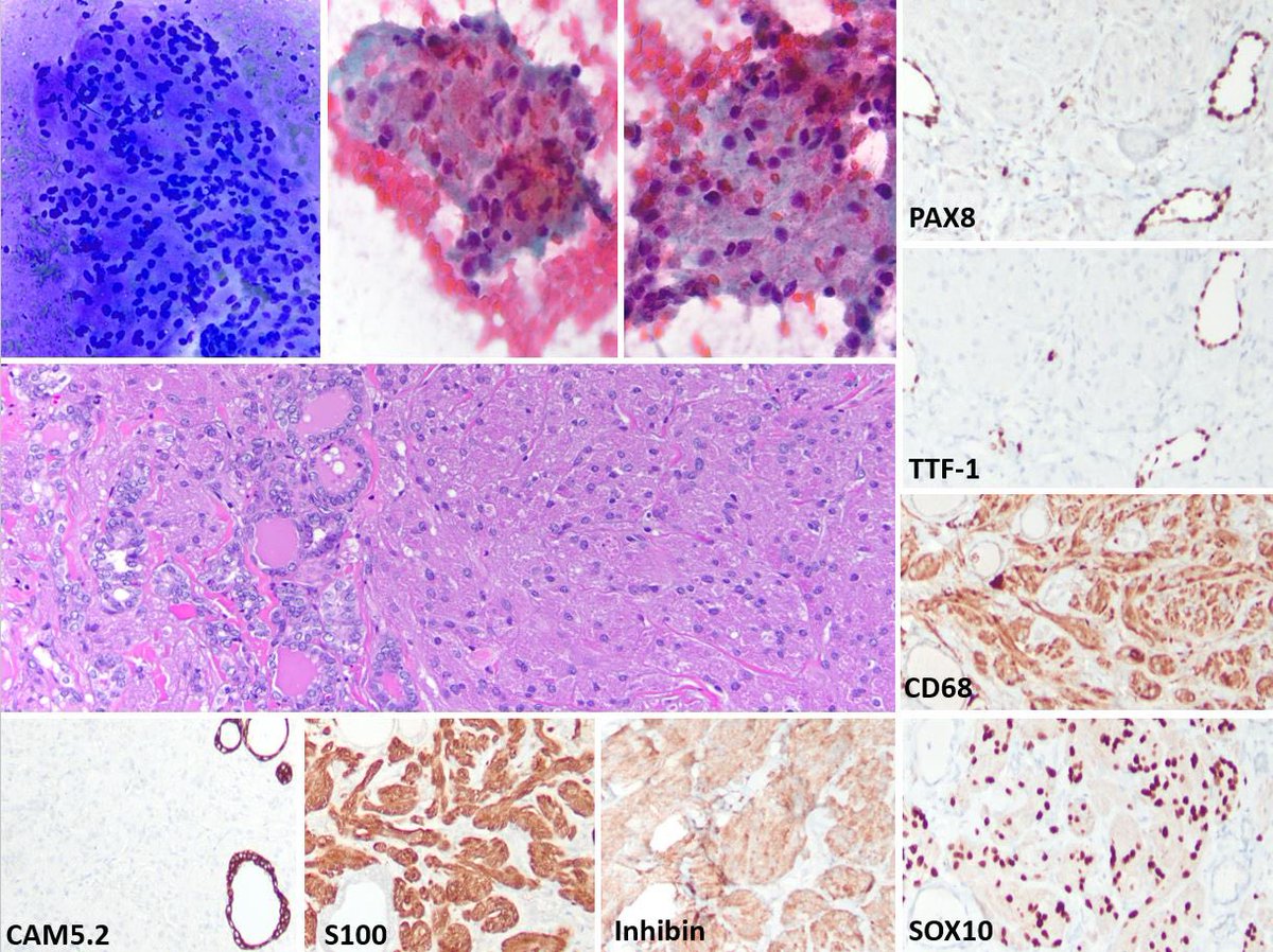 Dx: Granular Cell Tumor of Thyroid!