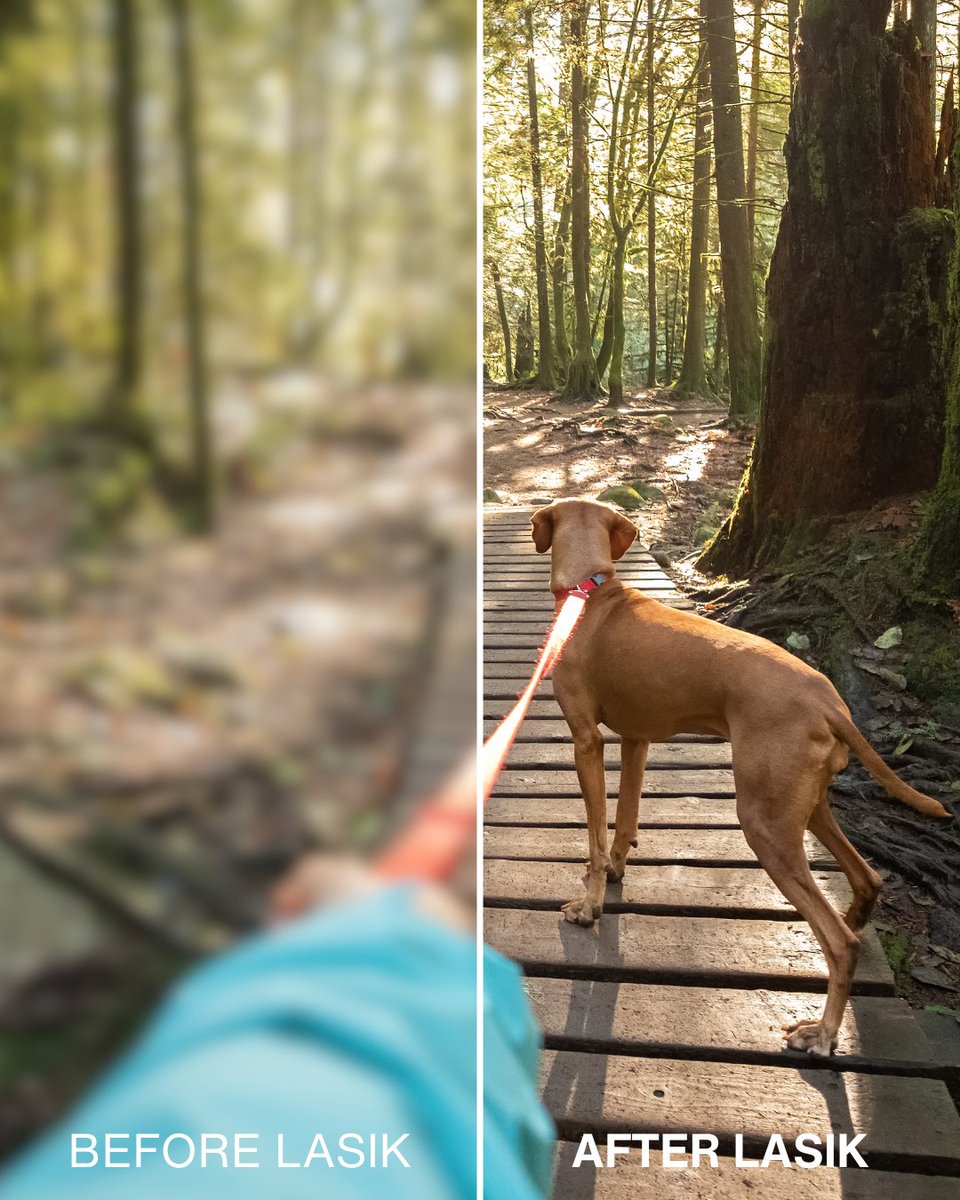 See the difference LASIK makes... literally. Discover How We Can Help — For Free (by booking a consultation using the link in our bio).

#eyesurgeonsofindiana #eyesurgeons #eyesurgeonsindiana #lasik #beforelasik #afterlasik