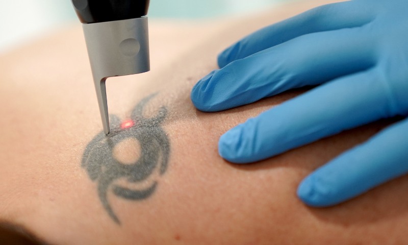 ¿Pensando en eliminar un #tatuaje? En <a href="/grupopedrojaen/">Grupo Pedro Jaén</a> contamos con tecnología láser de última generación y dermatólogos expertos para tratar incluso los casos más complejos. 
¿Quieres saber más? Llámanos al 914317861

grupopedrojaen.com/especialistas-…