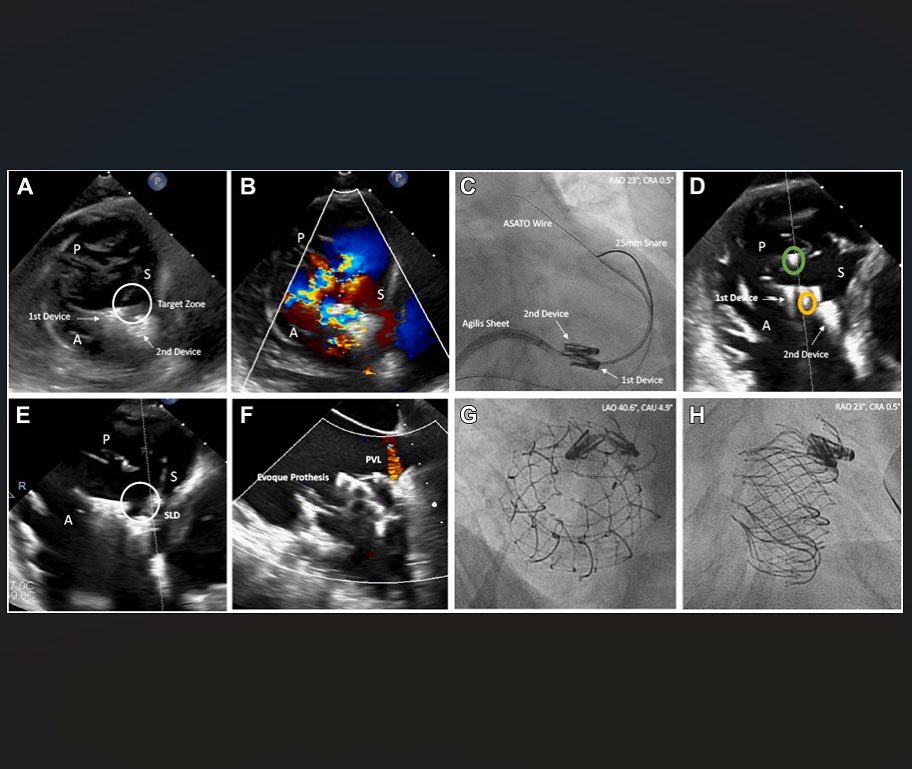 #Wire-Based Interventional Clip Excision (WICE Procedure) to Allow Tran... sciencedirect.com/science/articl…
🔍 New #treatment approach for recurrent tricuspid regurgitation after #TEER!
#TricuspidValve #TTVR #StructuralHeart #InterventionalCardiology #CardiologyResearch #AgPolzin