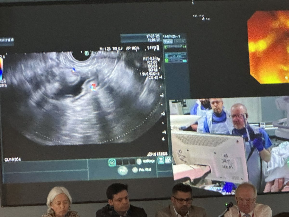 Umair Kamran (@umairkamran11) on Twitter photo Masterly demonstration of the first stage of EDGE procedure by <a href="/NEndoscopy/">Prof John Leeds</a> and <a href="/manuknayar/">Manu</a> from Newcastle in Manchester advanced endoscopy symposium #MAES25 .
<a href="/smkahlon/">Sajjad Mahmood</a> <a href="/MohsenSubhani/">Mohsen Subhani</a> <a href="/SyedGerdezi/">Anjum Gardezi MD</a> <a href="/abdullahaabbasi/">Abdullah Abbasi, MD</a> Masterly demonstration of the first stage of EDGE procedure by <a href="/NEndoscopy/">Prof John Leeds</a> and <a href="/manuknayar/">Manu</a> from Newcastle in Manchester advanced endoscopy symposium #MAES25 .
<a href="/smkahlon/">Sajjad Mahmood</a> <a href="/MohsenSubhani/">Mohsen Subhani</a> <a href="/SyedGerdezi/">Anjum Gardezi MD</a> <a href="/abdullahaabbasi/">Abdullah Abbasi, MD</a>