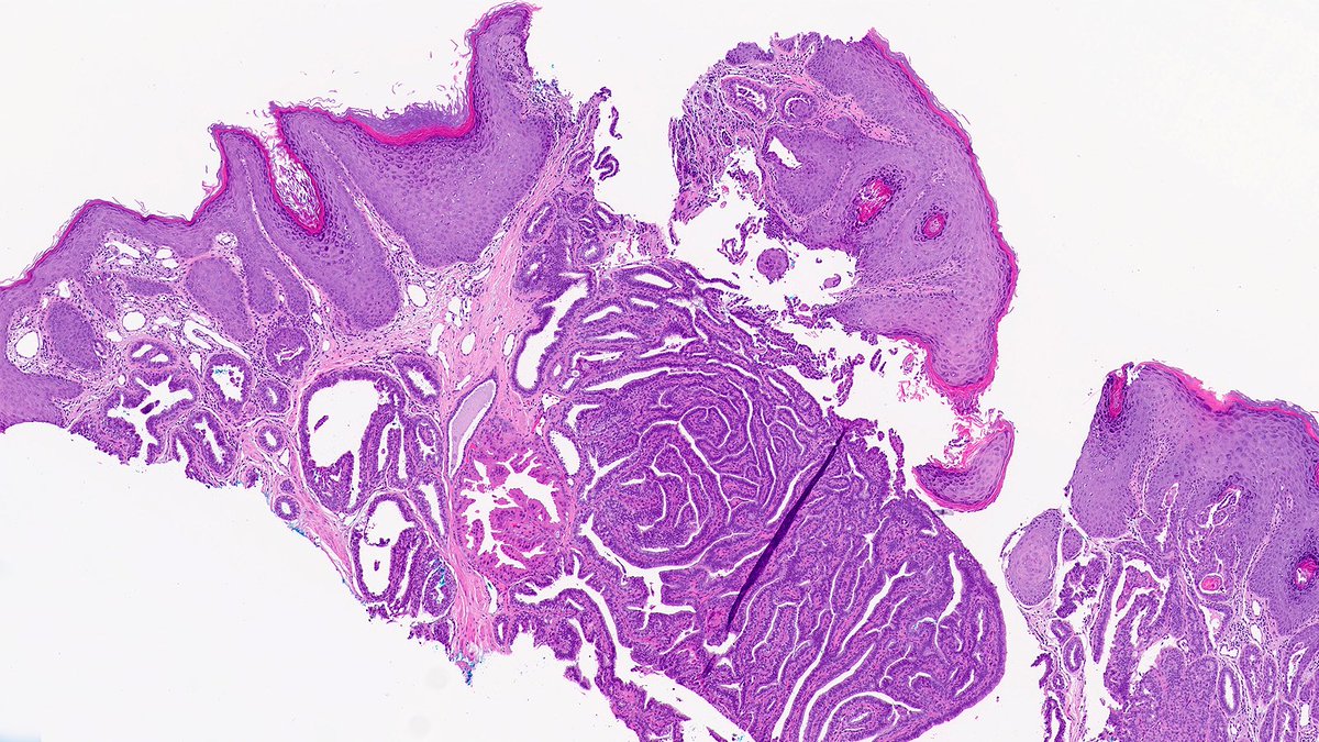 Case of Nipple Adenoma 🔬

Nipple adenoma is a benign proliferative epithelial process of the superficial lactiferous ducts that may erode the overlying squamous epithelium. 

#PathX #PathTwitter #breastpath