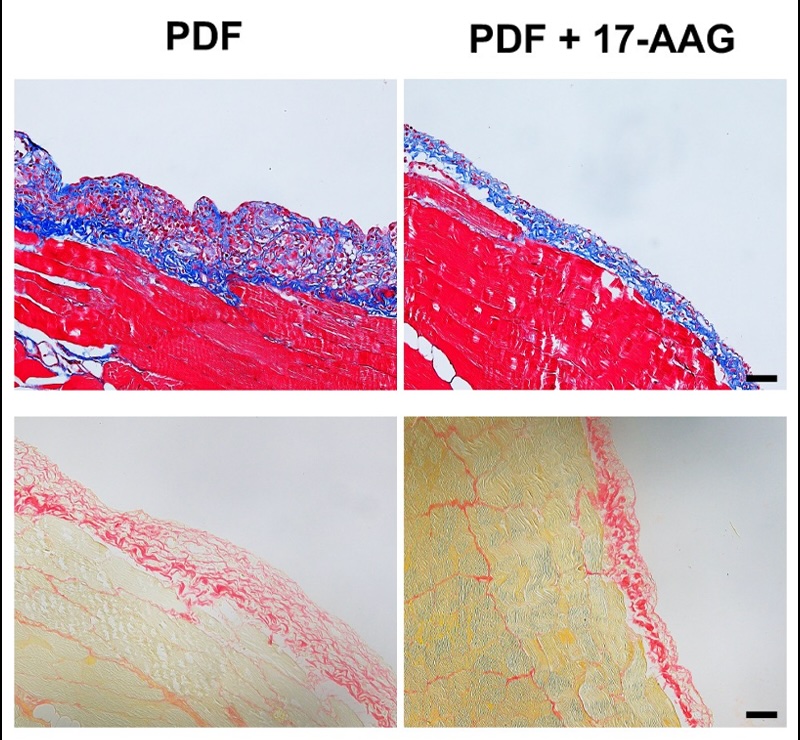 pathsoc's tweet image. Latest Editor’s Choice! #TheJournalOfPathology:
'Genetic deletion of histone deacetylase 6 prevents peritoneal fibrosis via suppression of heat shock protein 90 deacetylation'
…thsocjournals.onlinelibrary.wiley.com/doi/10.1002/pa…
#Pathology #PeritonealFibrosis #HSP90 #PathSoc #Editorschoice