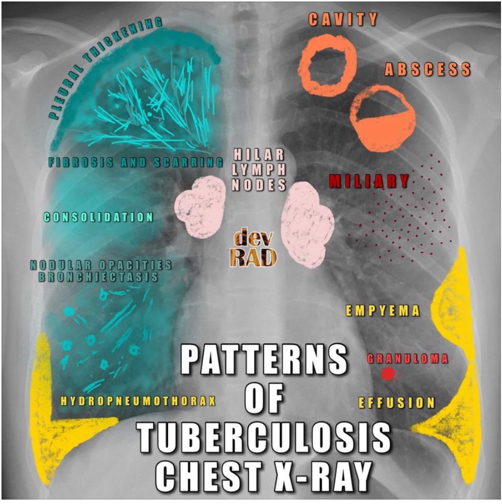 MedIntCHMH's tweet photo. Patrones de tuberculosis en radiografía de tórax. https://t.co/c11DKCHc8r