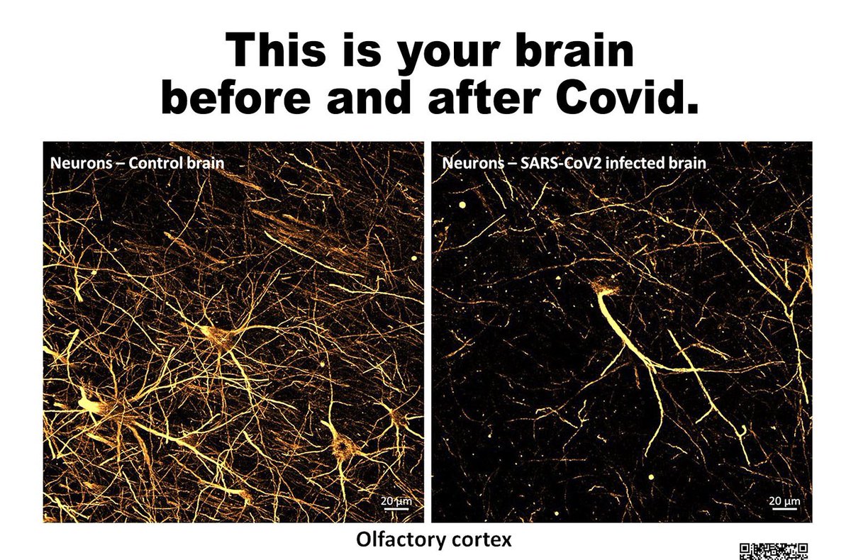 JamesThrot's tweet image. Let’s talk about COVID, brain damage & society.
Specifically, what happens when a neurotropic virus repeatedly infects the population, targeting the frontal lobe & almost nobody talks about the consequences?
This thread is for the skeptics.
I’m a neurologist, stay with me 🧵