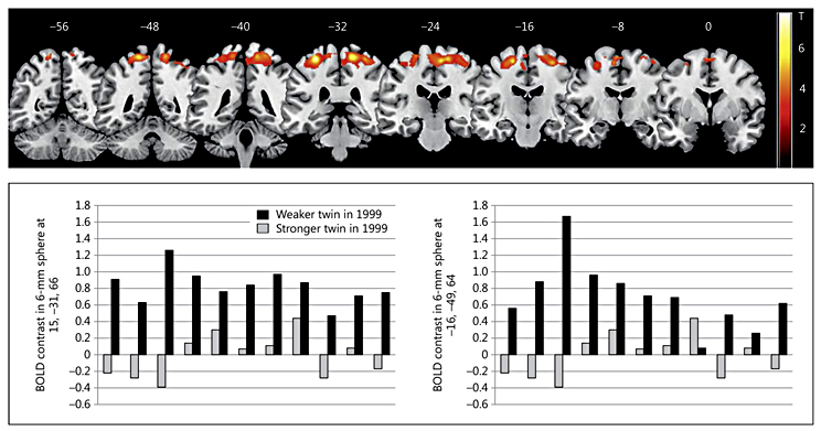 Stronger legs are associated with larger brain volume &amp; slower cognitive decline.

🧵1/7