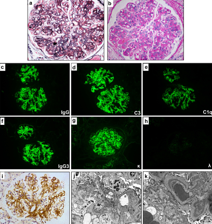 Adolescent Proliferative #Glomerulonephritis with #Monoclonal Immunoglobulin Deposits
doi.org/10.1016/j.ekir…

#KIRNephrologyRounds