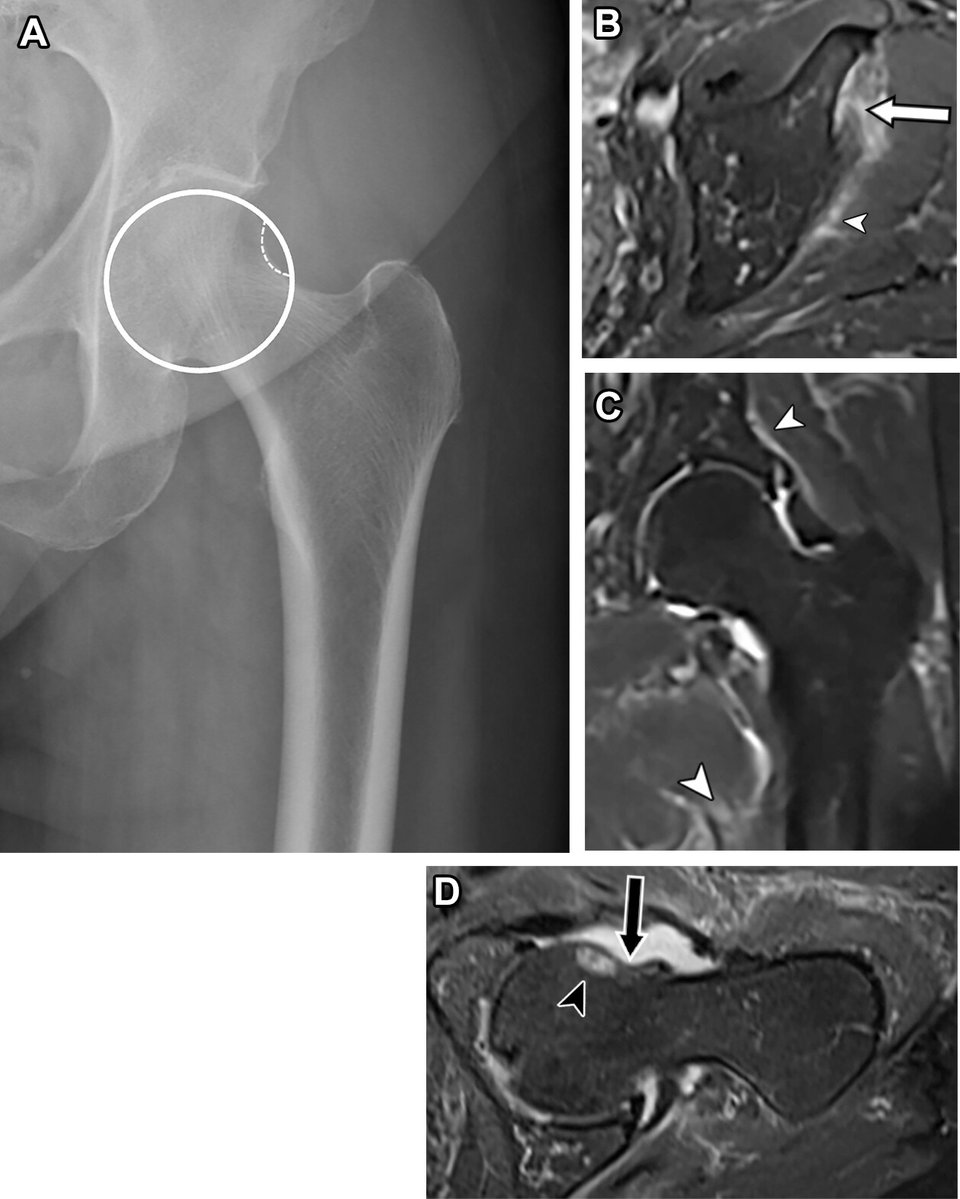 RSNA's tweet image. A recent RadioGraphics article offers a comprehensive guide to the evolving concepts and definitions of hip instability. Read the full article, “Hip Microinstability: Novel Concepts and Comprehensive Imaging Evaluation.” bit.ly/3GC78kp