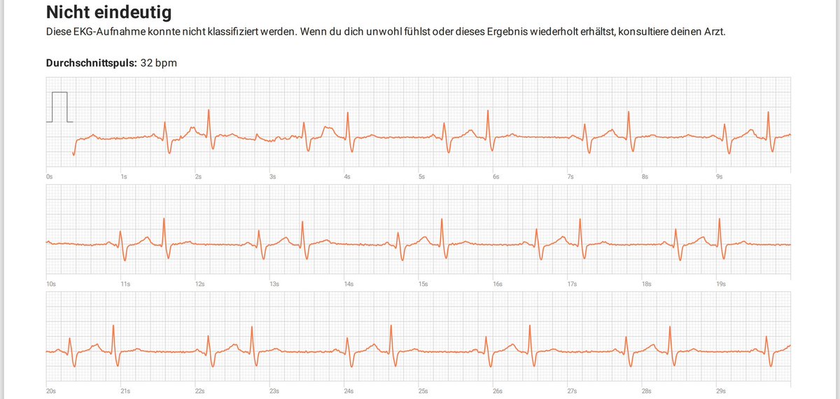 1-channel smartwatch ECG, 30 seconds; rhythm?