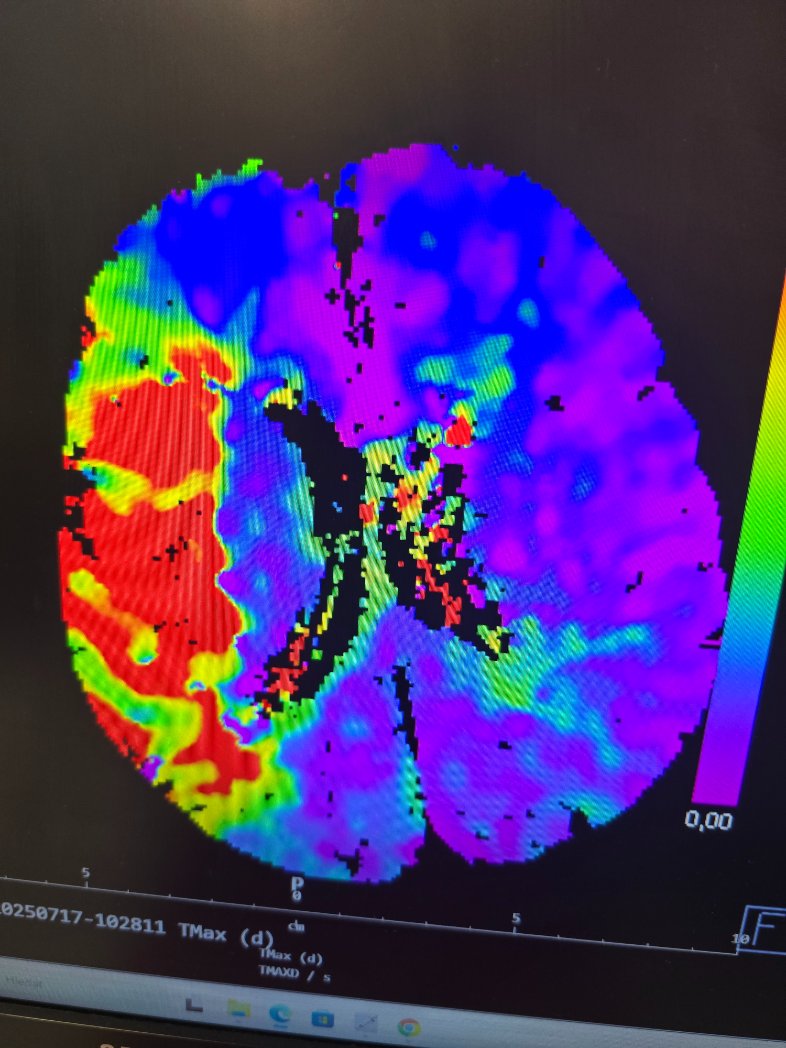 1/ Time is brain - mozková mrtvice 3 #angiologie

Pojďme si dnešním seniorem s těžkou mrtvicí připomenout, jak zásadní je zavolat si včas

Senior, 88 let, plně soběstačný, aktivní život, běžné nemoci, se zveřejněním souhlasí

Dnes v 8.05 náhle vzniklá porucha řeči, těžká porucha