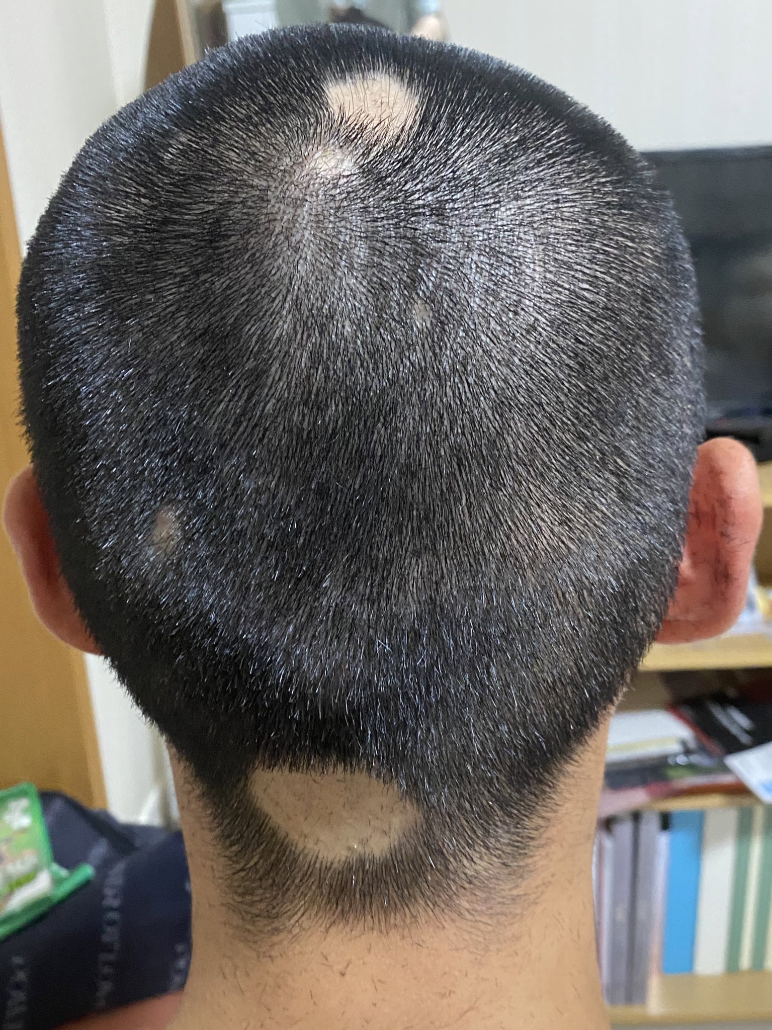 坊主頭さんまとめ 坊主からの〜」 坊主からの！ここまで半年くらいで伸びました