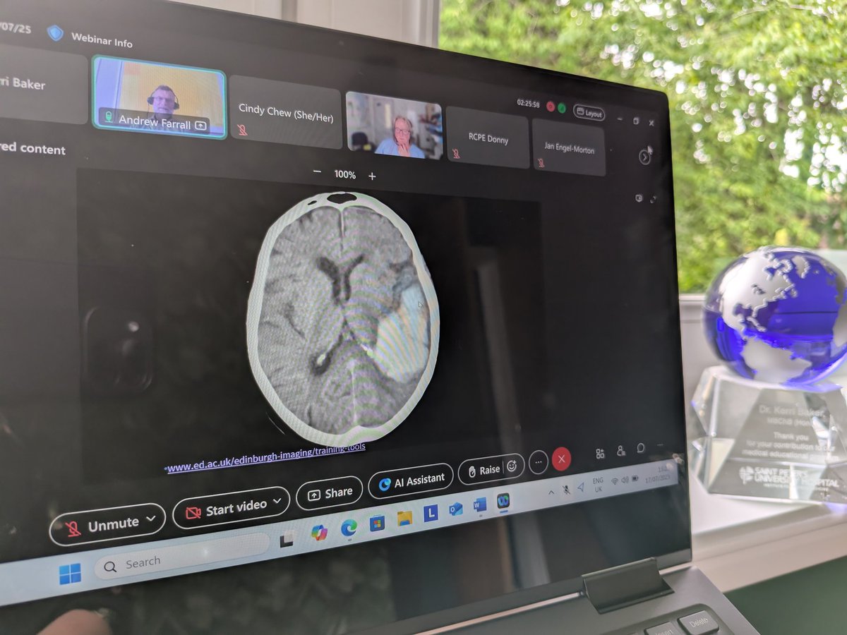 KerriBaker20's tweet image. Acute weakness, with differentiation between acute/subacute/chronic on CT; old blood can be mistaken for infarct! Who do we thrombolyse? What about BP control?
A helpful & dynamic run through by Dr Sarah Keir and Prof Andrew Farrell @RCPEdin #rcpeRadio25 @ShiYunZhao @scotrad