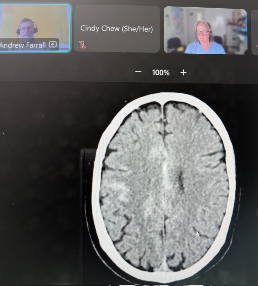 KerriBaker20's tweet image. Odd pattern of (non-traumatic) intracerebral bleeding? Consider CVST! CTV probably over-requested, but worth considering where it's more likely a zebra than a horse.
#rcpeRadio25 @RCPEdin @scotrad @ShiYunZhao