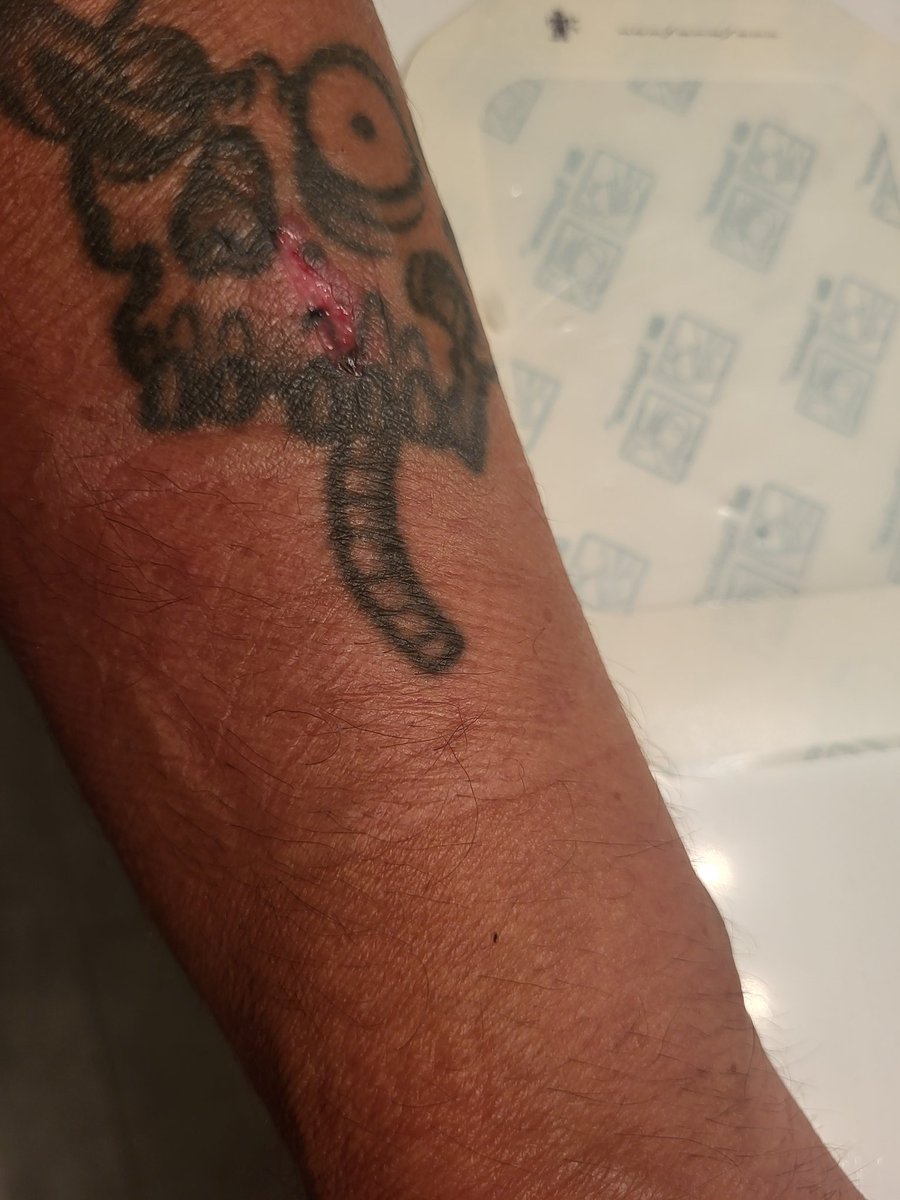 I was instructed to leave the original dressing on for 3 days and I changed it yesterday I think it's already looking much better, what say you?