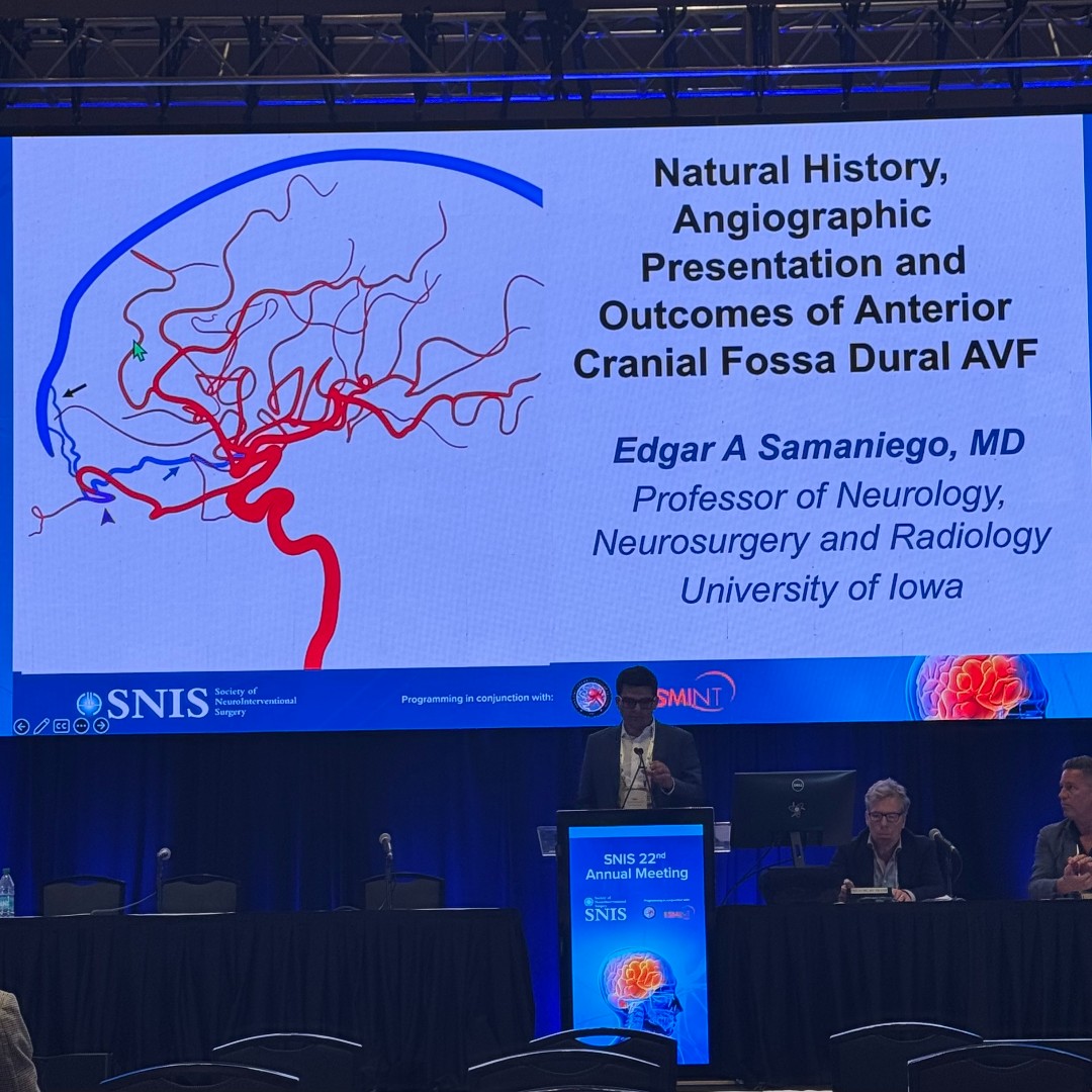JNIS_BMJ's tweet image. Dr. Samaniego presenting on anterior cranial fossal dAVFs #SNIS2025 @SNISInfo @esmintsociety @cvsection @cvsection_aanscns
@fcalbuquerque51 @dr_mchen @DanniDiestro @MattAmansMD @ducruetaf
@MattFusco_MD @DrAltschul @cruzcerebri @niko_mou @aliyasiddiqui04