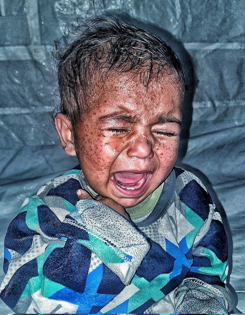 IPalestinia's tweet image. Save childhood, people 馃槬 Joud is feeling severe burning and pain, and her health is getting worse than before. Jude needs you 馃挃 Be the reason for Jude's recovery. Do nate even a little. chuffed.org/project/126429