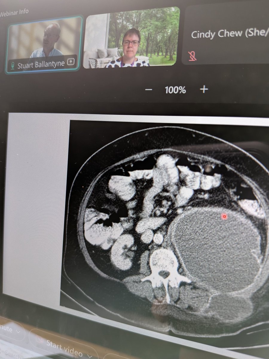 KerriBaker20's tweet image. Extremely impressive psoas abscess courtesy of Dr Stuart Ballantyne & Dr Sian Gilchrist @RCPEdin @scotrad #rcpeRadio25.
Should prompt consideration of spinal infection e.g. local discitis