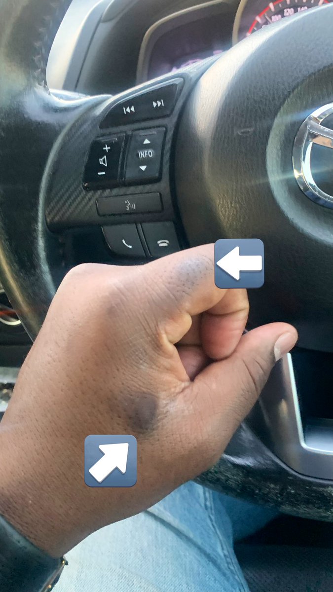 Tebogo (@tebogom3rd) on Twitter photo I bite my index finger and between my thumb and index finger …… (those black marks) <a href="/Kgomotsomeso/">EliteLadyGirlWoman</a> <a href="/KayaON959/">Kaya ON 959</a> <a href="/GlenLewisSA/">glenzito</a> <a href="/skhumbi/">official_</a> #drive959 I bite my index finger and between my thumb and index finger …… (those black marks) <a href="/Kgomotsomeso/">EliteLadyGirlWoman</a> <a href="/KayaON959/">Kaya ON 959</a> <a href="/GlenLewisSA/">glenzito</a> <a href="/skhumbi/">official_</a> #drive959
