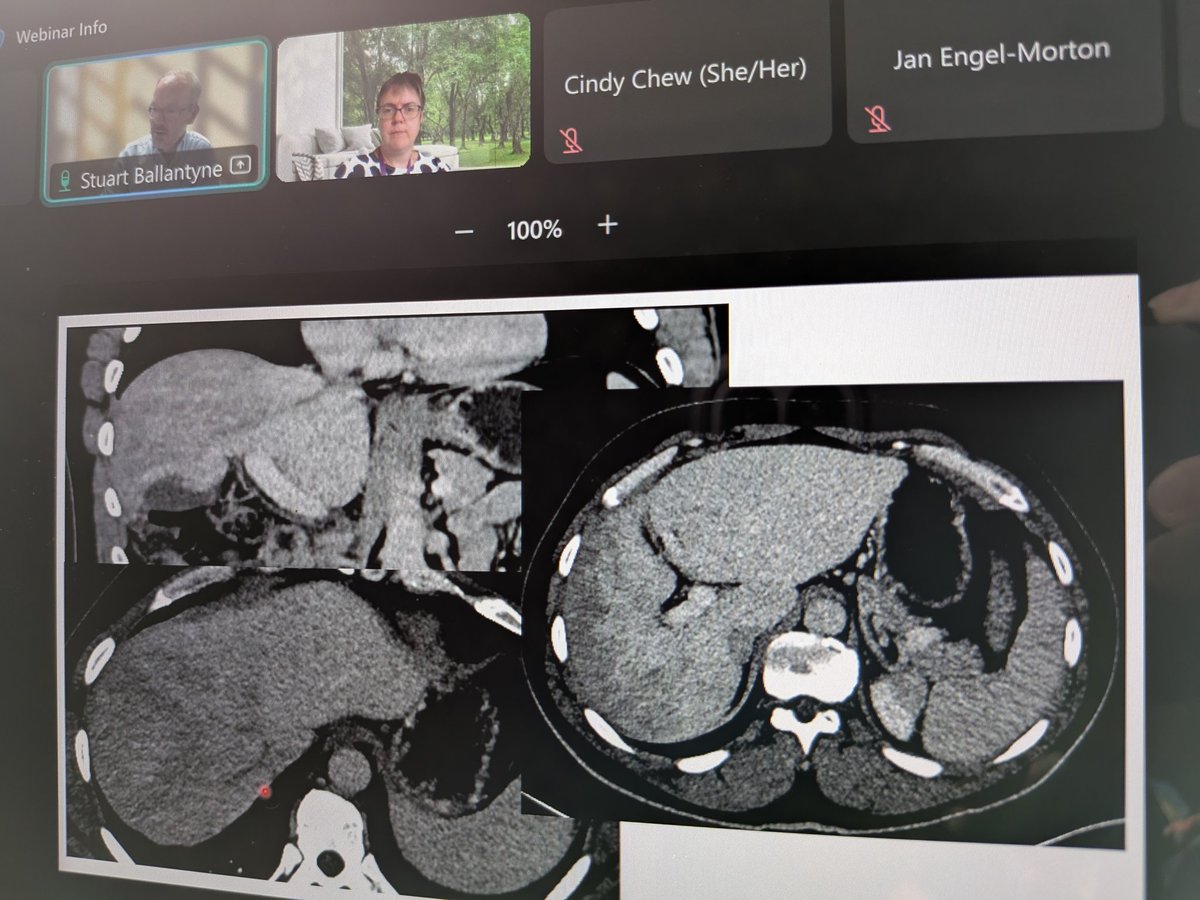 KerriBaker20's tweet image. We need to be able to spot Budd Chiari when we're not expecting it, as we don't often see these patients hyper-acutely - if missed, pt presents later with ascites and portal HTN, which we want to avoid!
#rcpeRadio25 @RCPEdin @scotrad @ShiYunZhao