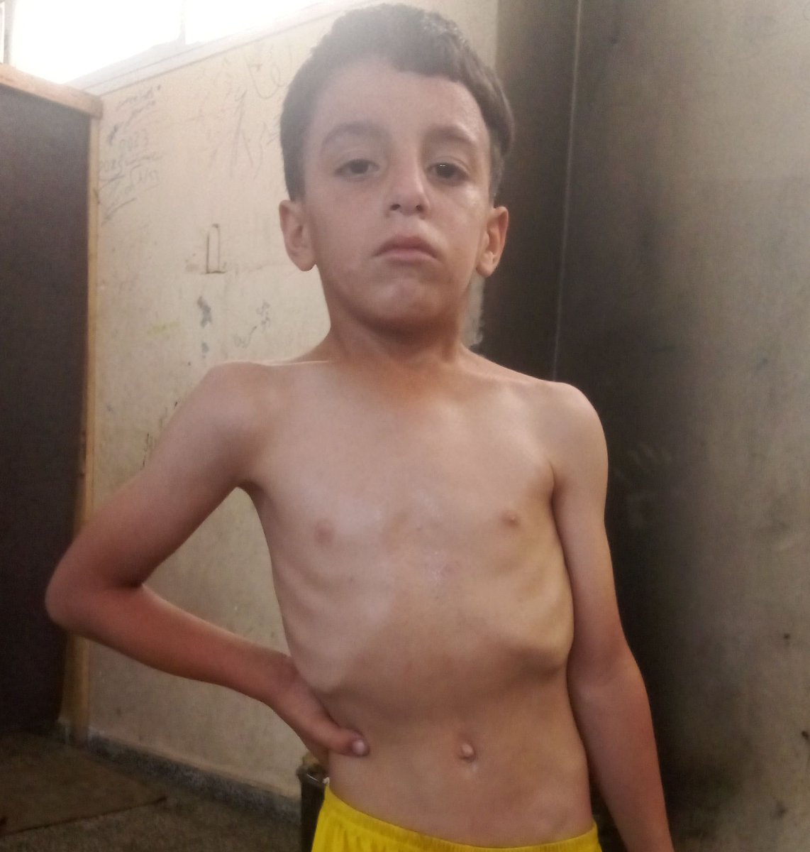 RozeatG's tweet image. My poor son Adam has malnutrition due to lack of food. He is hungry and has not eaten for days. We do not have a piece of bread. Please help me. Donate for my orphan child. We have no breadwinner. I beg you, do not leave us alone.🙏🙏😭😭😭
chuffed.org/project/137260…