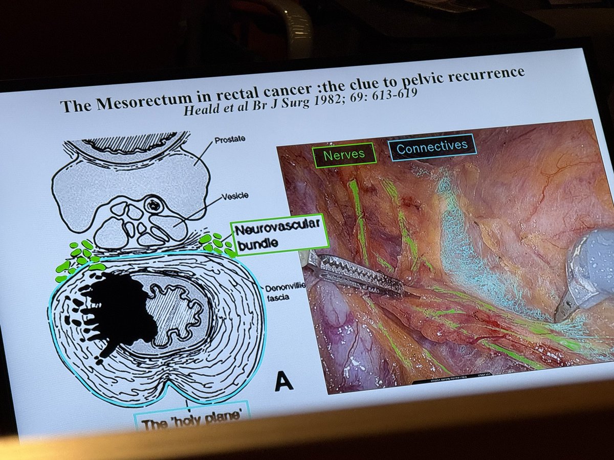 AjhungMD's tweet image. Amazing day of robotic surgery and AI at #SRS25.
A privilege to co-chair the event with Filippo Filicori (AI2M)
Takeaways:
💡Tons of AI technological innovation already here
💡Surgeons are craving a data-driven approach to improving patient outcomes
💡Surgical AI will only…