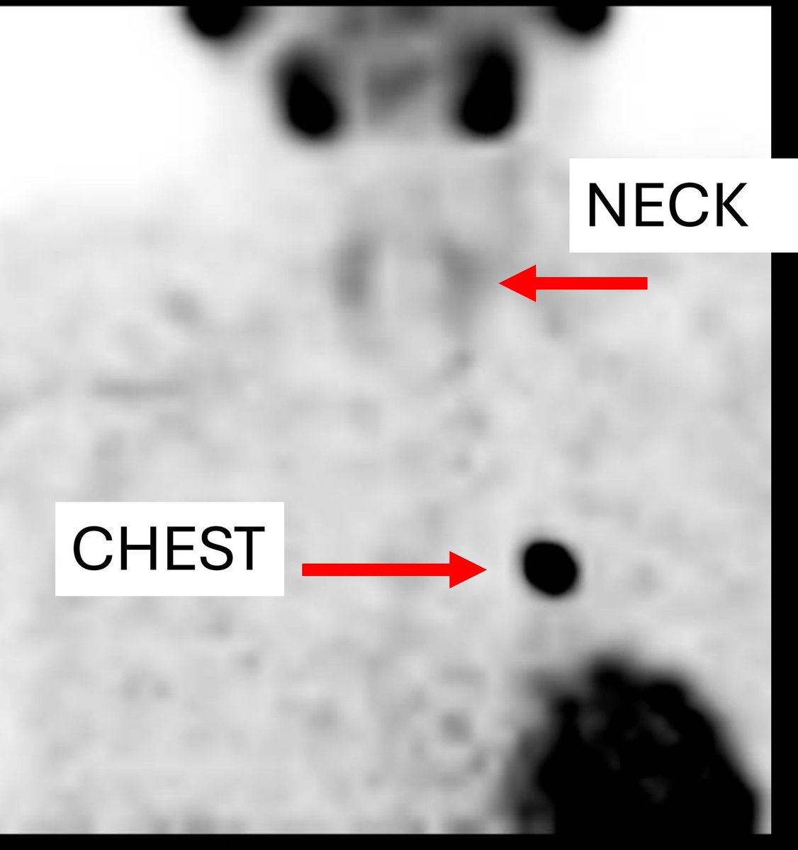 TheAAES's tweet image. Did you know parathyroid glands don’t always stay in their usual spots?
Sometimes, overactive glands are found in ectopic locations—like the chest, behind the esophagus, or even inside the thyroid!
Advanced imaging can help track them down before surgery.
#PAM2025
