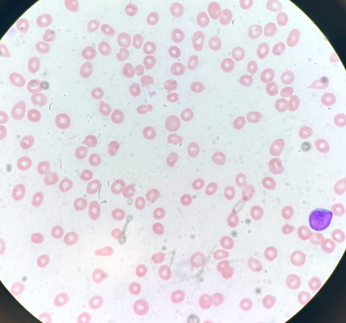 PathologyKate's tweet image. Peripheral blood. Anemia, thrombocytopenia, dacryocytes, and blasts.
Tell me a diagnostic history!