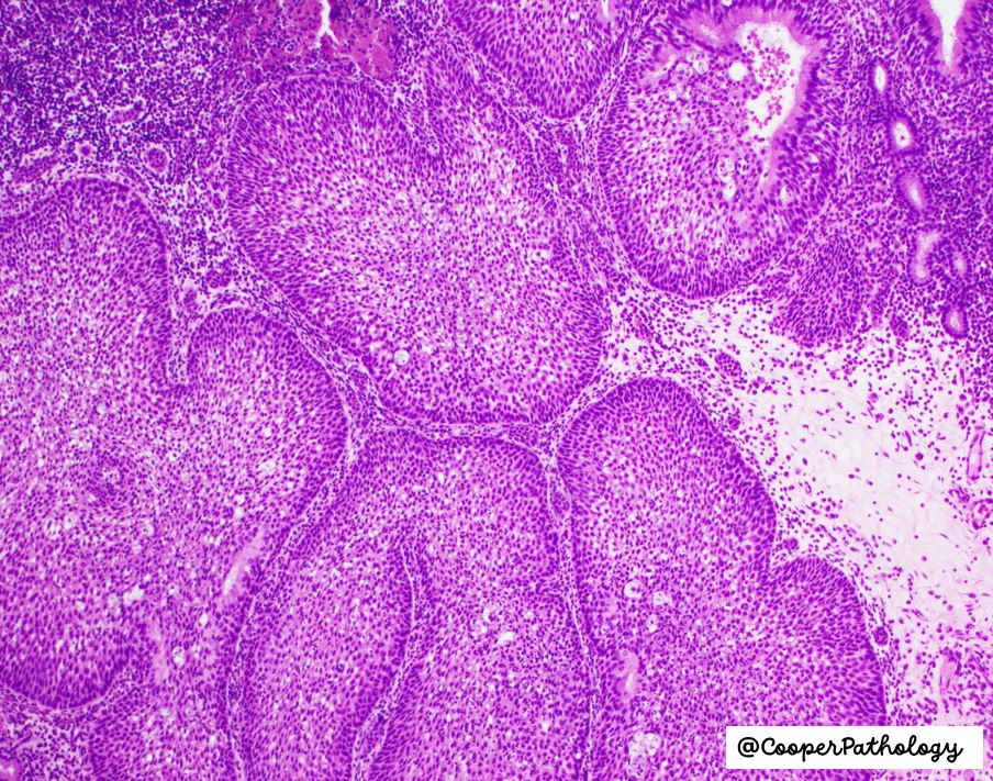 CooperPathology (@cooperpathology) on Twitter photo #pathology #pathtwitter Sinonasal Inverted Papilloma, a benign but locally aggressive tumor with endophytic growth. Presents as a nasal mass, often with obstruction or epistaxis.
<a href="/navale_pooja/">Pooja Navale MD</a> @aileengraceA @ujoneja <a href="/324Amandeep/">Amandeep Aneja</a> @ruthbirbe @gord_zhu @dejan1295208 #pathology #pathtwitter Sinonasal Inverted Papilloma, a benign but locally aggressive tumor with endophytic growth. Presents as a nasal mass, often with obstruction or epistaxis.
<a href="/navale_pooja/">Pooja Navale MD</a> @aileengraceA @ujoneja <a href="/324Amandeep/">Amandeep Aneja</a> @ruthbirbe @gord_zhu @dejan1295208