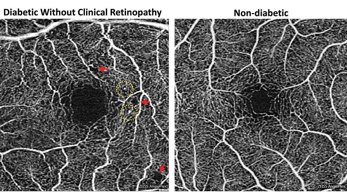 Microvascular Protective Effects Vary Among Anti-diabetic Drugs

Metformin and sulfonylureas show limited benefit, in contrast to newer agents like iSGLT-2i, DPP-IVi and possibly GLP-1 drugs.

Read more: reviewofoptometry.com/article/microv…

#optometry #optometrist #eyecare #diabetes #retina