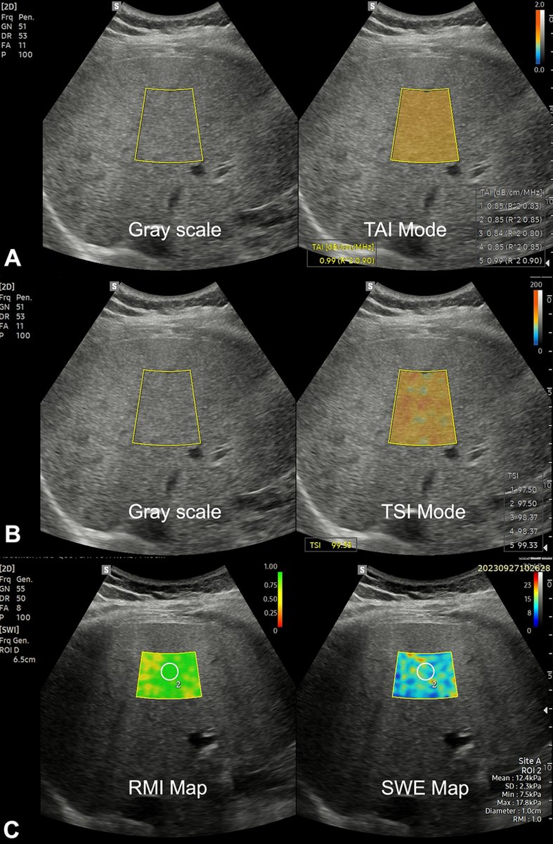 radiology_rsna's tweet photo. From Huang and Li et al: Quantitative US using tissue attentuation imaging, tissue scatter-distribution imaging, and 2D shear-wave elastography can accurately assess metabolic dysfunction–associated steatotic liver disease (MASLD). https://t.co/lp4ZGP7NvK https://t.co/OBuElqByKS