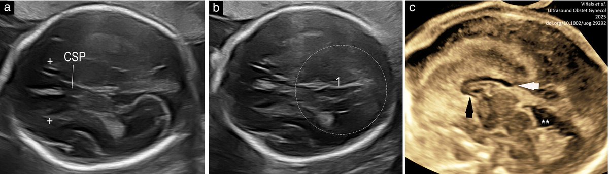 New #openaccess study by Viñals et al. shows that evaluation of the anterior and posterior complexes may improve the performance of fetal brain ultrasound screening and enhance detection of potential corpus callosal dysgenesis. Read online in #UOGJournal now!