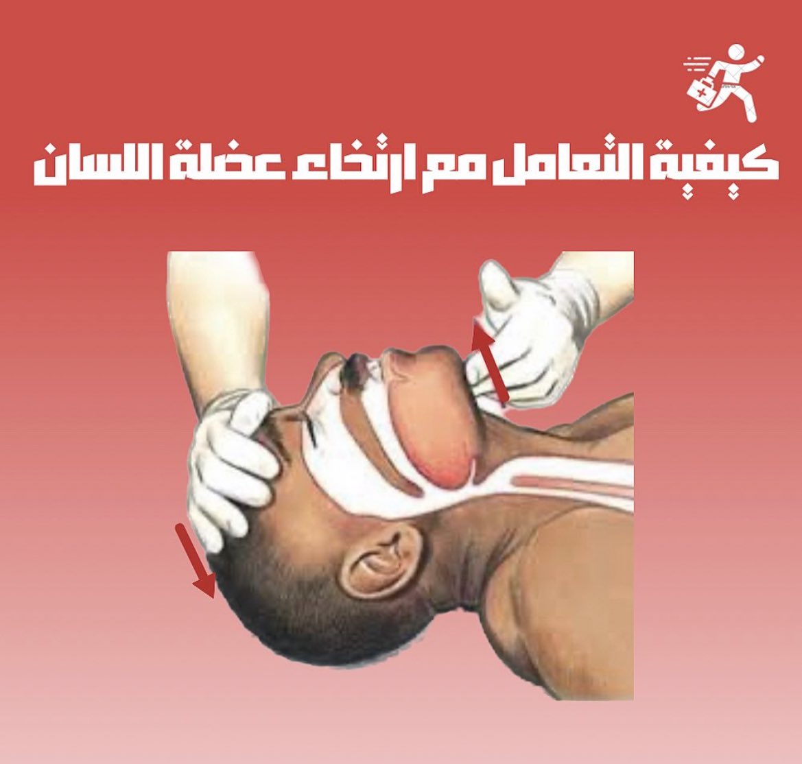 إنقاذ مصاب بارتخاء عضلة اللسان يتطلب اتخاذ خطوات سريعة لضمان سلامته. إليك وصف سريع للإجراءات التي يمكن اتباعها:

١-تمديد الشخص على الارض
٢-الجلوس على جانب الشخص المصاب
٣-إمالة راس المصاب الي الخلف ورفع الذقن الي الاعلى لفتح مجرى التنفس بطريقة الخمسة 🤚🏻، اثنين✌🏻 الموضحة بالصورة