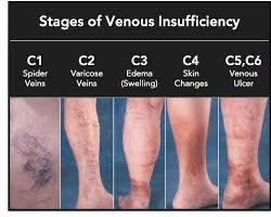 Swollen legs is Stage 3 of Chronic Venous Insufficiency so there’s no way Trump and his doctors didn’t know about this condition for a long time. We’ve been blatantly lied to for years about his symptoms like his bruising. Will the media obsess over this as they did over Biden?
