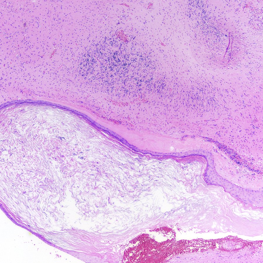 CraigHorbinski's tweet image. Nice example of an epidermal inclusion cyst right next to cerebellar cortex in the posterior fossa. #pathology #neuropath #pathtwitter