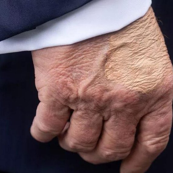 p_zuchowski's tweet image. Prezydent USA Donald Trump przeszedł badania w związku z puchnącymi nogami i siniakiem na dłoni. Lekarz zdiagnozował przewlekłą niewydolność żylną, a siniak wynika z przyjmowania aspiryny i częstego ściskania dłoni - powiedziała rzeczniczka Białego Domu Karoline Leavitt.…
