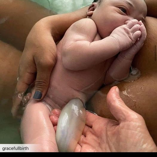 FELibrary_'s tweet photo. "This is what an umbilical cord is supposed to look like.
White. Limp. Translucent.
Because its mission is complete.
Every last drop of cord blood has been delivered to the baby - as designed.
But that’s not what usually happens.
In most hospitals, the cord is clamped and cut within seconds.
The baby cries, the team moves fast, and parents are told “it’s routine.”
No one stops to ask…
What was in that cord?
And where did it go?
Let’s break it down:
Cord blood is not extra.
It’s loaded with:
🩸 Up to ⅓ of your baby’s total blood volume
🧠 Oxygen to protect the brain
🛡️ Immune cells to prevent infection
💪 Iron to prevent anemia
 STEM CELLS to repair and build tissue, organs, and immunity
This isn’t waste.
It’s a biological treasure.
So ask yourself… why is it clamped early?
Why are we told the cord is useless after birth, when the baby hasn’t even received all of what’s theirs?
And here’s the darker truth:
💰 That cord blood is worth thousands on the market
💰 The placenta is sold for stem cell research, vaccine development, skincare, cosmetics, and Big Pharma products
💰 Entire biotech companies are built on the lie that your baby’s leftovers are “medical waste”
But the parents?
They’re left in the dark.
Told it’s “no big deal.”
Told it’s just discarded.
While behind the scenes, someone else cashes in.
This system isn’t broken.
It was built this way.
But THIS photo shows what happens when you don’t comply.
When you wait.
When you let the birth unfold as it was designed.
When the baby receives all of their blood. Their protection. Their power.
This is the kind of image that makes people uncomfortable -
Because it exposes what most have never questioned.
But once you see it…
You can’t unsee it.
SEE. IT."
Dr. Jodi Shabazz