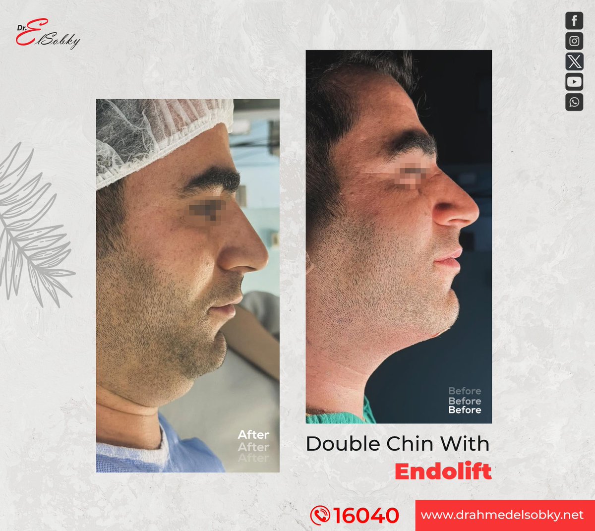 اتخلص من الذقن المزدوج وارفع مستوى جمال ملامح الوجه في مراكز أ.د أحمد السبكي للتجميل في وقت قياسي وبأحدث التقنيات في العالم.

📌للحجز والاستعلام: الخط الساخن 16040
#أ_د_أحمد_السبكي 
#تجميل