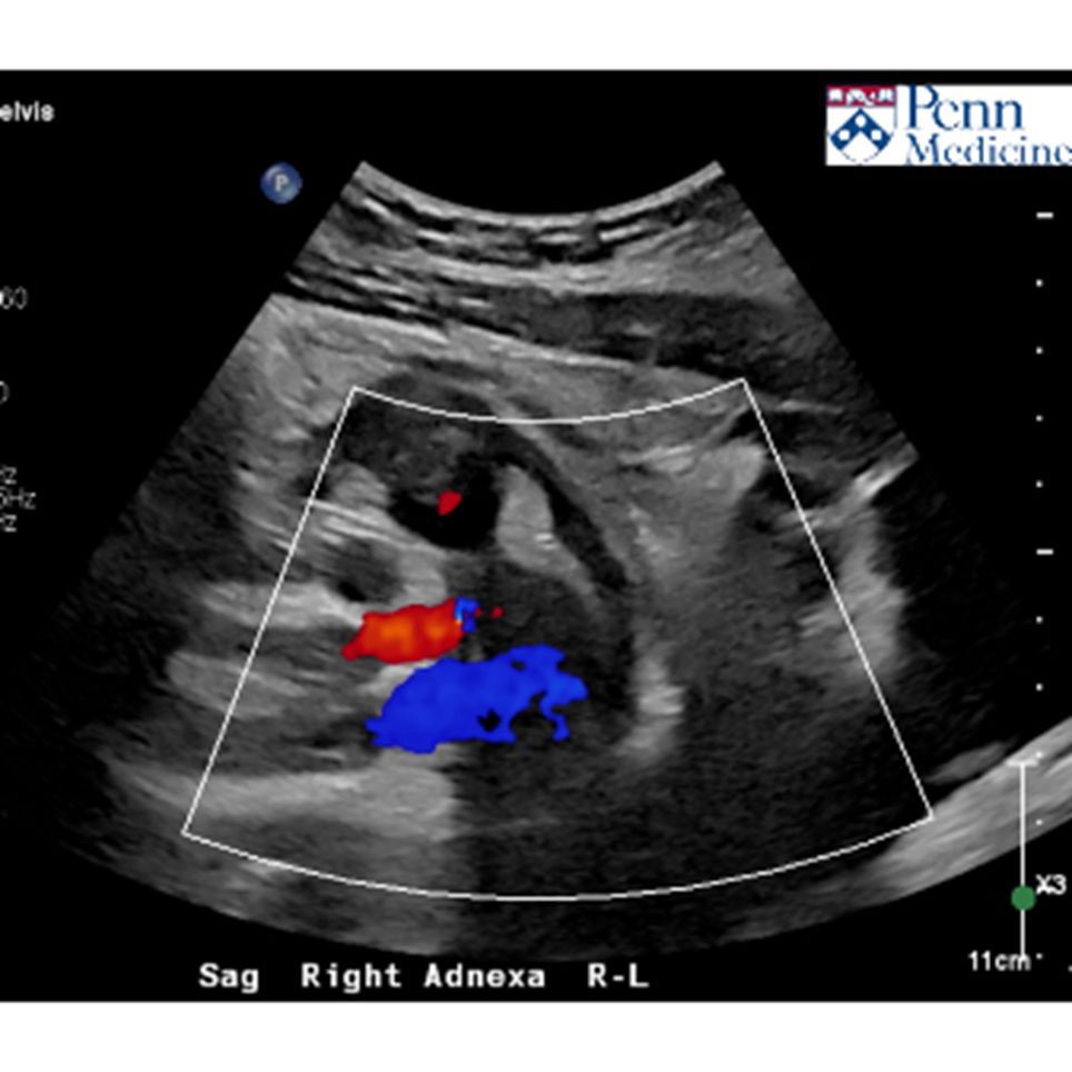 AuntMinnie's tweet image. Another case for your consideration: 20-year-old woman with worsening right lower quadrant pain #radiology @PennMedicine buff.ly/tKZ7CbC