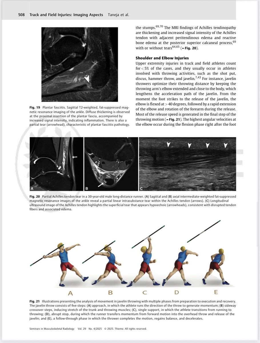 atultanejamd's tweet image. 🔥 Hot off the press! New Seminars in MSK issue is all about Summer Sports. Me and @MarceloBordalo co-authored a review on Track & Field Injuries — packed with practical tips for MSK/sports radiologists. Check it out at thieme-connect.com/products/ejour…
#SportsImaging #MSK #Radiology