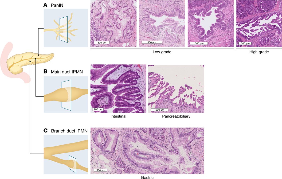 PancreaticCell's tweet image. Brian Pedro & @lauradelongwood outline the different histologic phenotypes, clinical characteristics, and neoplastic cell–intrinsic and –extrinsic drivers of pancreatic intraepithelial neoplasia and intraductal papillary mucinous neoplasm.
@jclinicalinvest |…