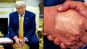 JackWallace888's tweet image. Trump’s likely the healthiest president ever—why obsess over a minor hand bruise?