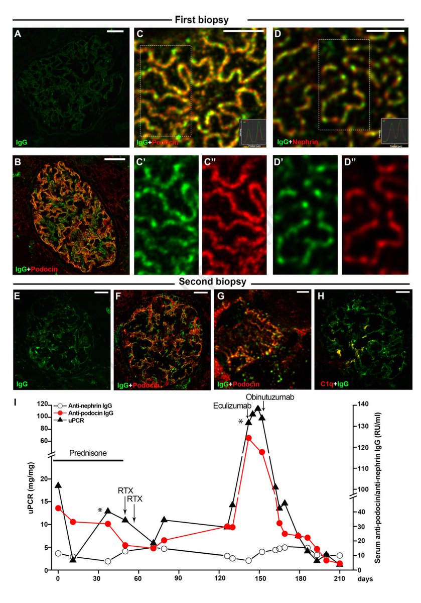 In our new study in KI Reports we show how longitudinal monitoring of serum anti-podocin antibodies guided immunotherapy in a difficult case of steroid- and rituximab-resistant nephrotic syndrome sciencedirect.com/science/articl…