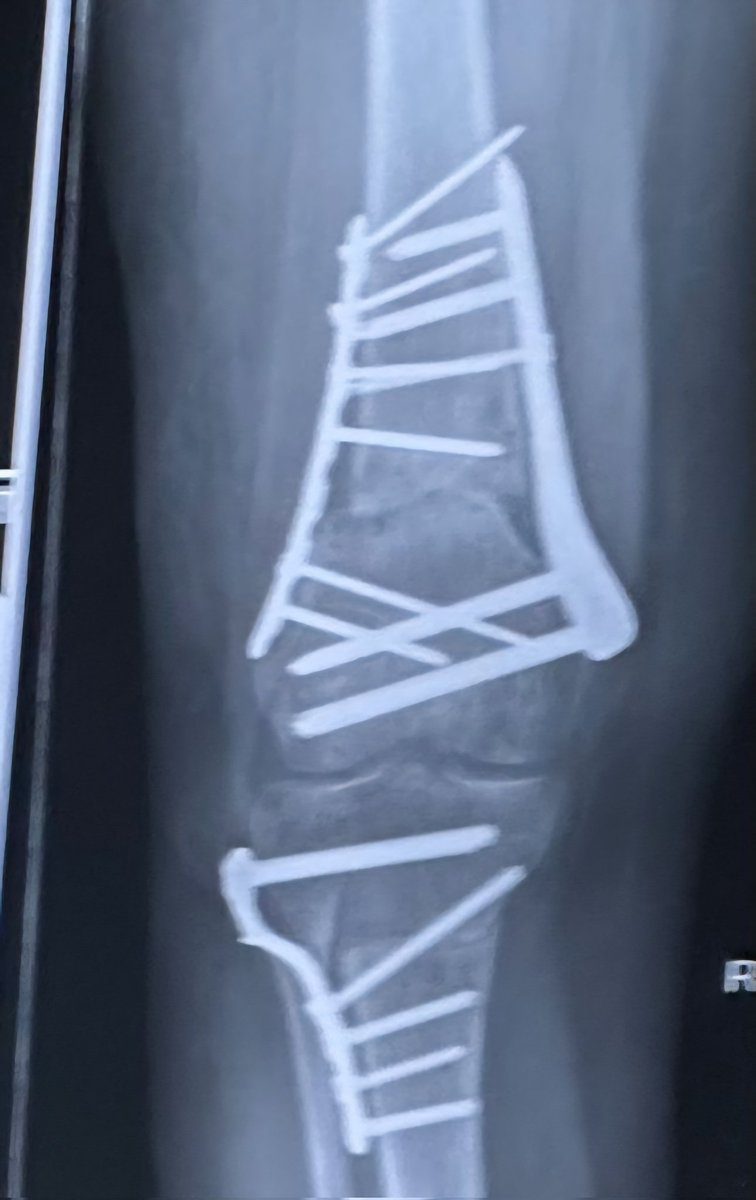 So I had another x-ray .. 5 and a half months after first op, 6 weeks after 2nd (emergency) op
My femur bone isn't healing as well as they would like so another month or no weight on it

2025 the year of set backs
2026 the year of the comeback 💪🏼