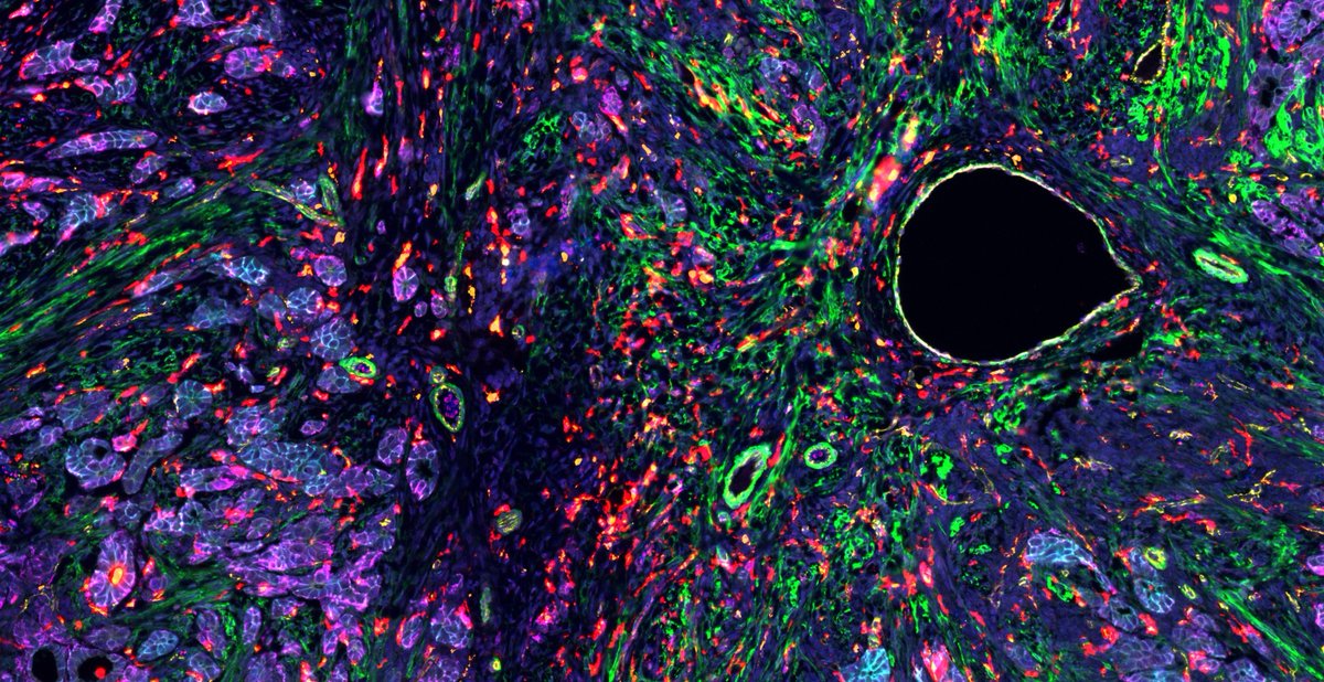 jacksonlab's tweet image. What does a rare ovarian tumor look like—cell by cell? This stunning image reveals a Sertoli-Leydig tumor at the single-cell level, highlighting the diverse cell types that make up its complex microenvironment. 🔬🧬🧪
Learn more: bit.ly/4fftXYl