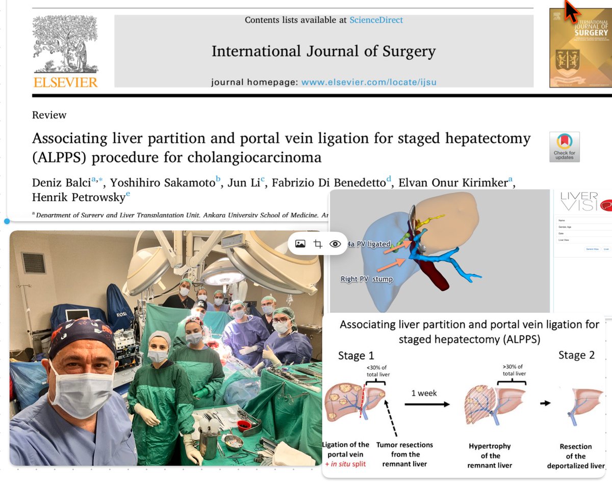 deniz balci (@dbalci) on Twitter photo Todays case in Istanbul: 
🔍 2nd stage of ALPPS for PeriHilar Cholangiocarcinoma #KlatskinTumor
we completed of 2-stage ALPPS procedure for a patient with  Klatskin tumor. The first stage was performed last week laparoscopic, and today we completed the second stage.
🧠 The Todays case in Istanbul: 
🔍 2nd stage of ALPPS for PeriHilar Cholangiocarcinoma #KlatskinTumor
we completed of 2-stage ALPPS procedure for a patient with  Klatskin tumor. The first stage was performed last week laparoscopic, and today we completed the second stage.
🧠 The