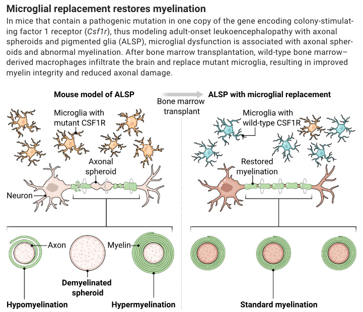 Using newly developed mouse models and a microglia replacement strategy, researchers in Science show that bone marrow transplantation could be used as an effective therapy for ALSP, a rare and fatal neurodegenerative disease.

📄: scim.ag/4kW4jsR
#SciencePerspective: