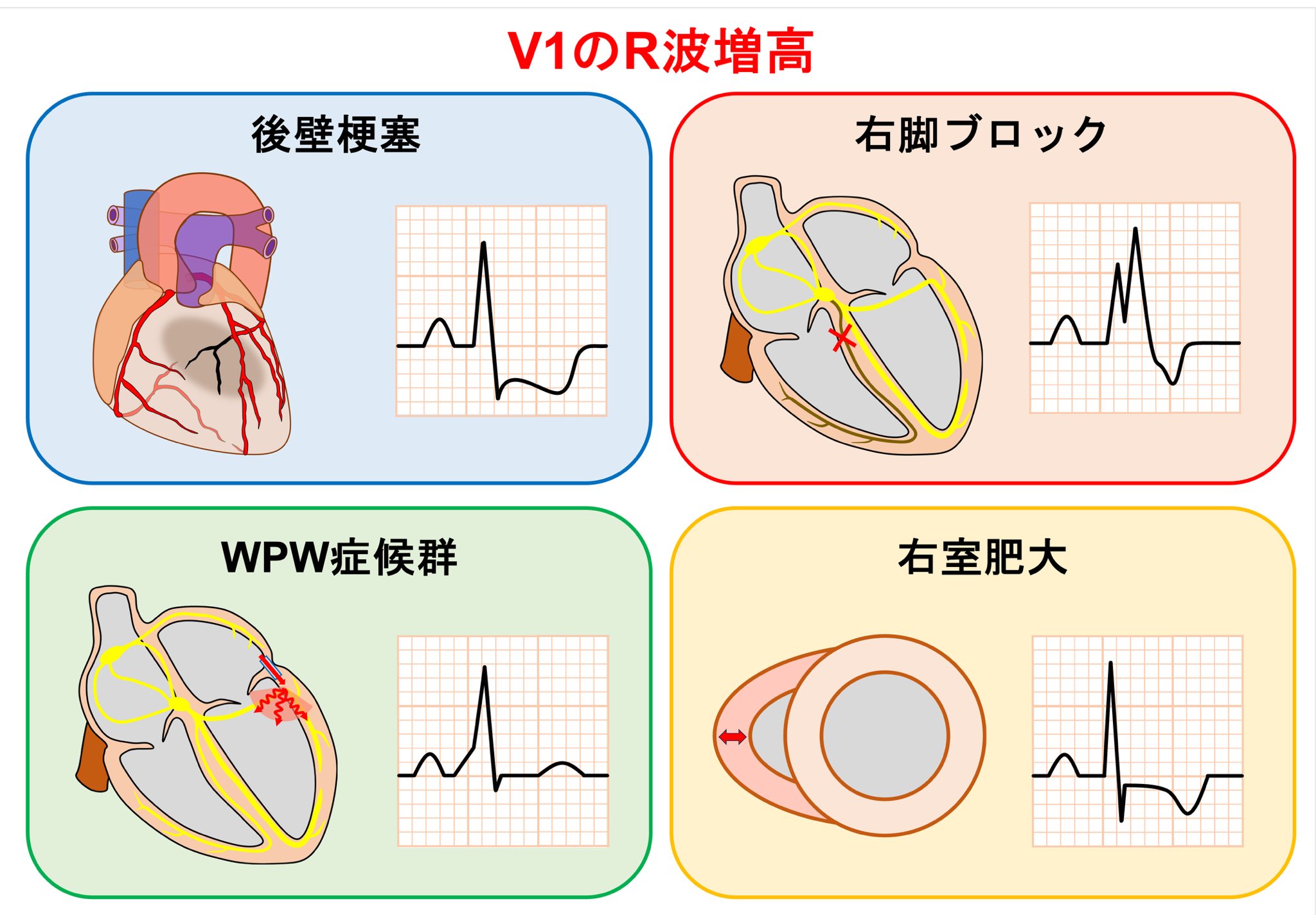ER心電図の超速診断 ER心電図の超速診断: 救急現場で初心者から役立つ | J.L.