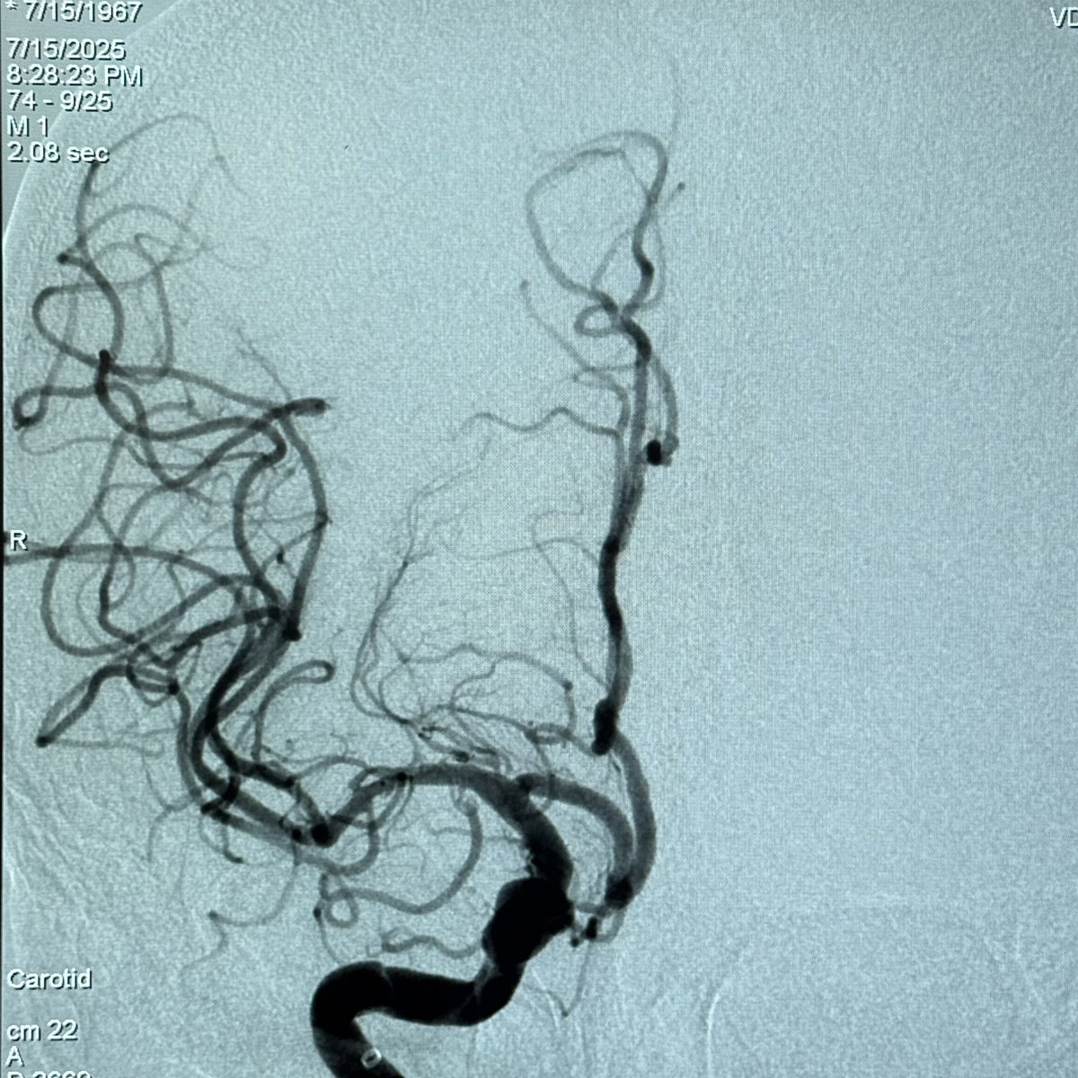 A case of MCA chronic total occlusion